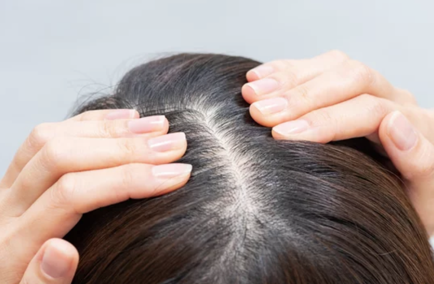 頭頂部や分け目から広がる