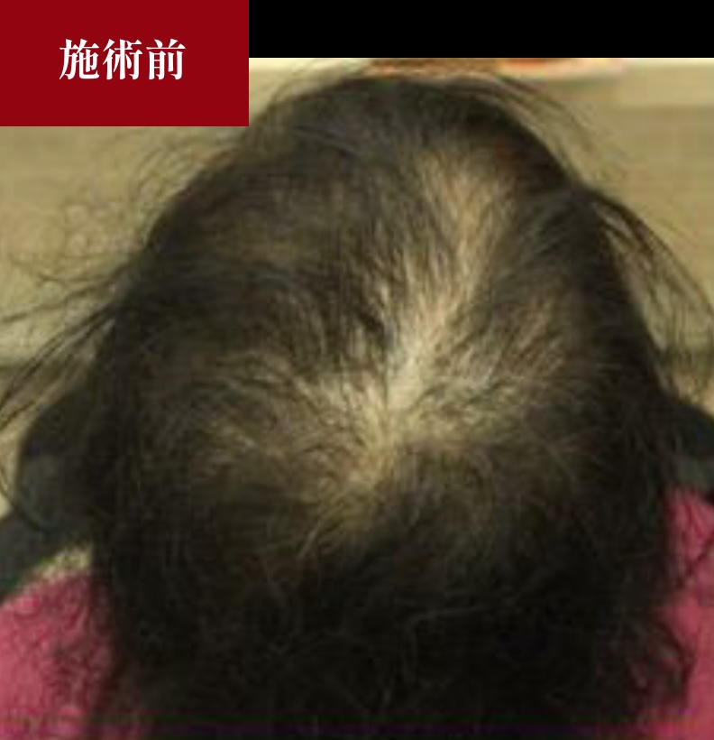 ヒト幹細胞培養液施術前