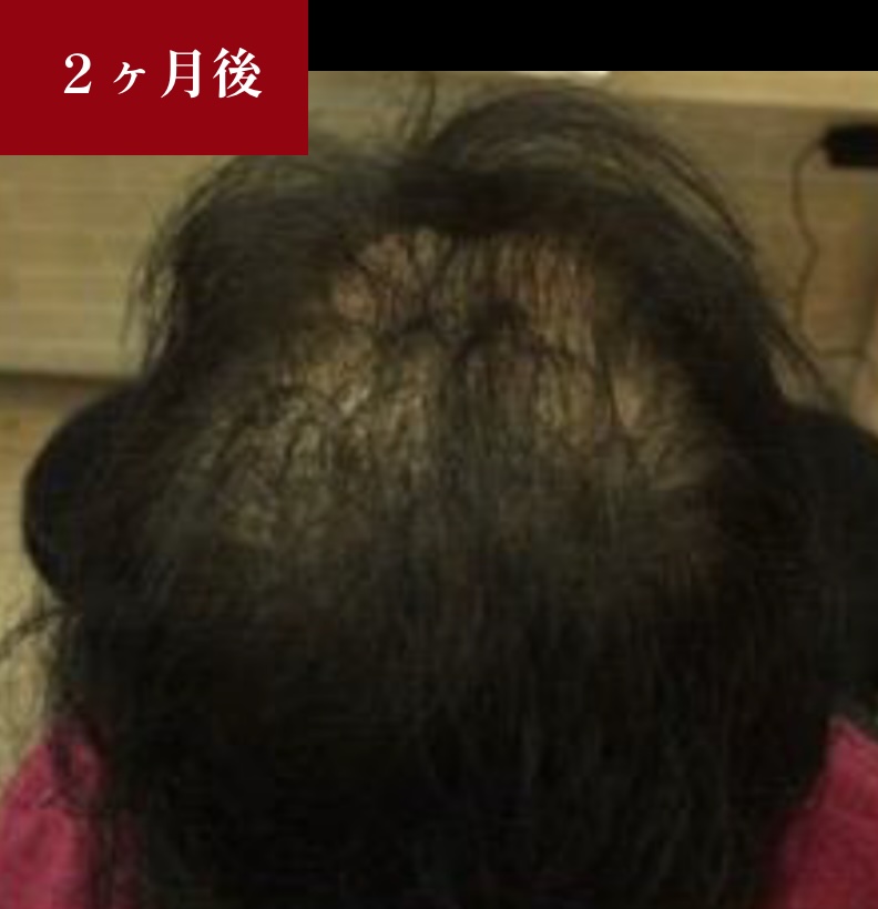 ヒト幹細胞培養液施術2ヶ月後