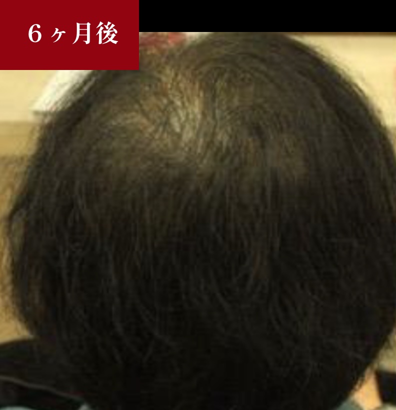 ヒト幹細胞培養液施術6ヶ月後